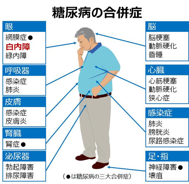 図：糖尿病の合併症を眼・呼吸器・皮膚・腎臓・泌尿器・脳・心臓・足・指の各器官と感染症について示す図。糖尿病の三大合併症は、眼に発症する網膜症、腎臓に発症する腎症、足・指に発症する神経障害である。特に眼においては、網膜症の他、白内障になるリスクが高く、糖尿病の予防が眼の健康につながるといえる。