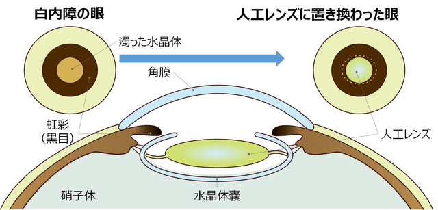 図1：水晶体の袋の中に埋め込まれた人工の眼内レンズ