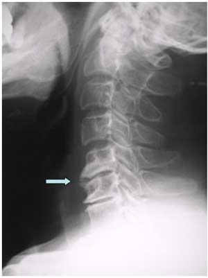 図1：首の椎間板を示すレントゲン画像。椎間板が飛び出ていることを示している