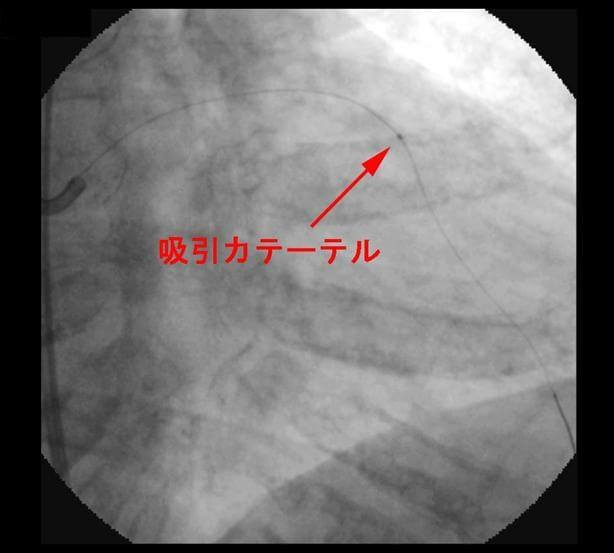 図2：ガイドワイヤー挿入後、血栓吸引を示す例の造影写真