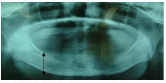 図3：比較的良好な下顎骨のレントゲン画像。歯肉の盛り上がりが比較的高いことを示す