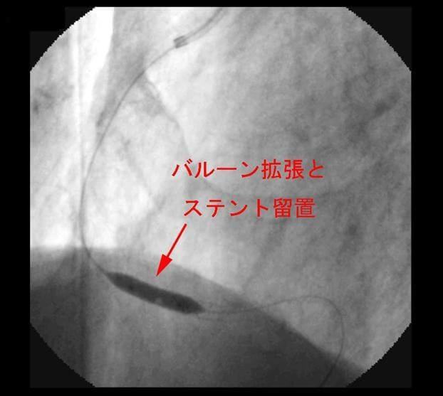 図5：バルーン拡張とステント留置 した脳画像