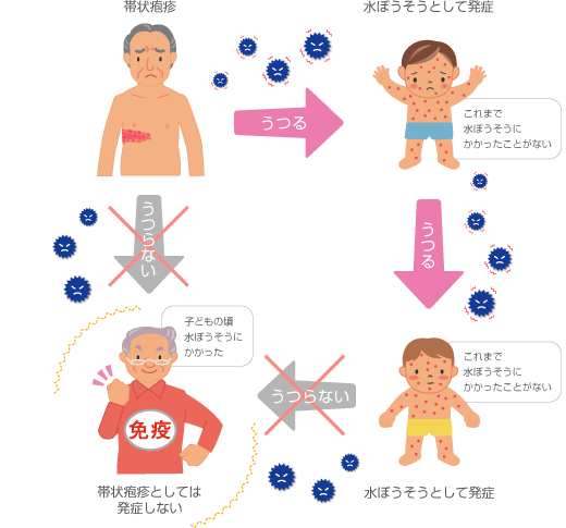 図1：帯状疱疹を発症する仕組みを示す図。これまで水疱瘡にかかったことがない人には帯状疱疹患者から水疱瘡ウイルスが感染し、水疱瘡として発症します。子供の頃に水疱瘡にかかった人は免疫があるため、帯状疱疹患者や水疱瘡患者かウイルスはうつらず、帯状疱疹を発症しません。